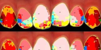 Fig. 2 Esempio di immagini dei risultati spettrofotometrici dopo metodica in office al 6% di perossido di idrogeno. Per ogni immagine pima dello sbiancamento dentario (sinistra) e dopo lo sbiancamento (destra).