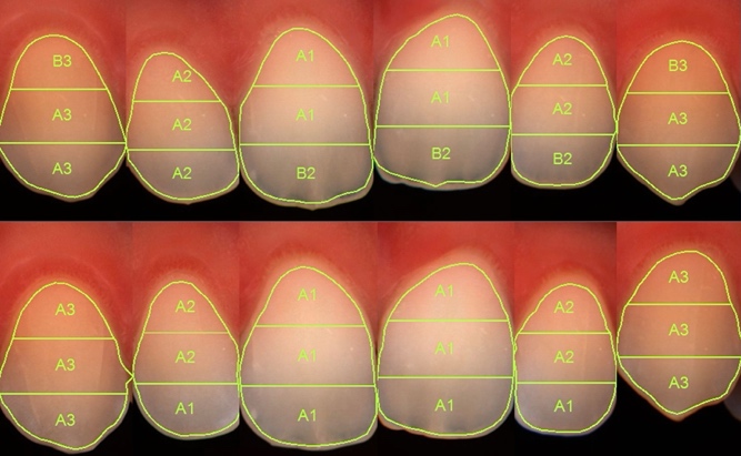 Fig. 2 Esempio di immagini dei risultati spettrofotometrici dopo metodica in office al 6% di perossido di idrogeno. Per ogni immagine pima dello sbiancamento dentario (sinistra) e dopo lo sbiancamento (destra).