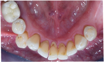 Fig. 2B Fotografia intraorale linguale