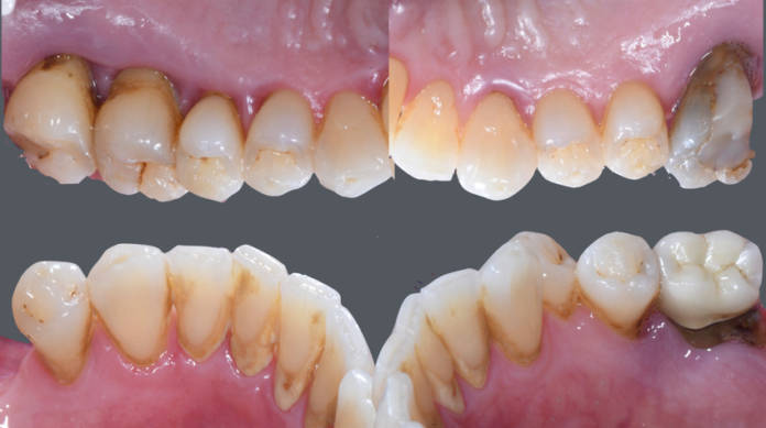 Fig. 2C-2F Fotografie intraorali palatali e linguali