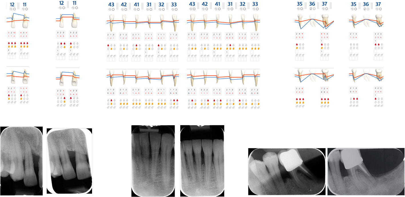 Fig. 9 Cartella parodontale e radiografie dei siti significativi: rivalutazione 3 anni.